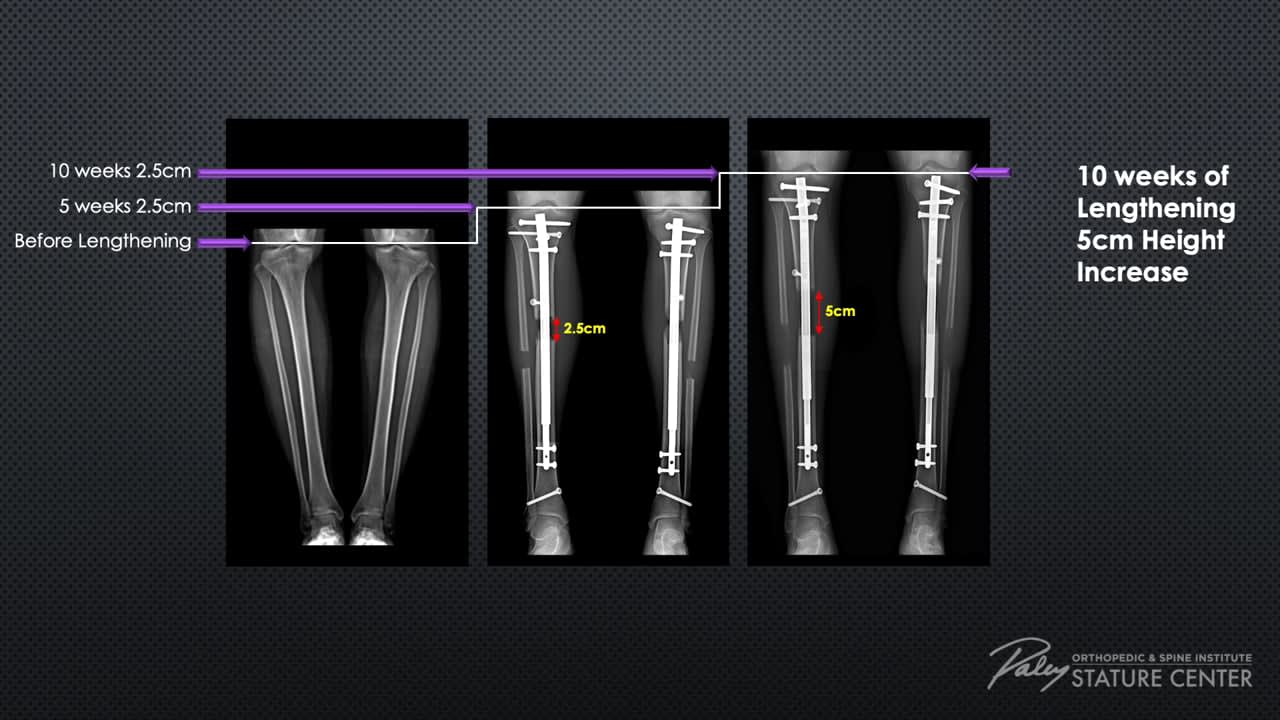 Tibia Lengthening